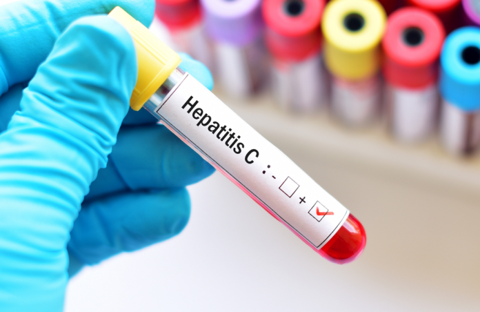 hepatitis C
